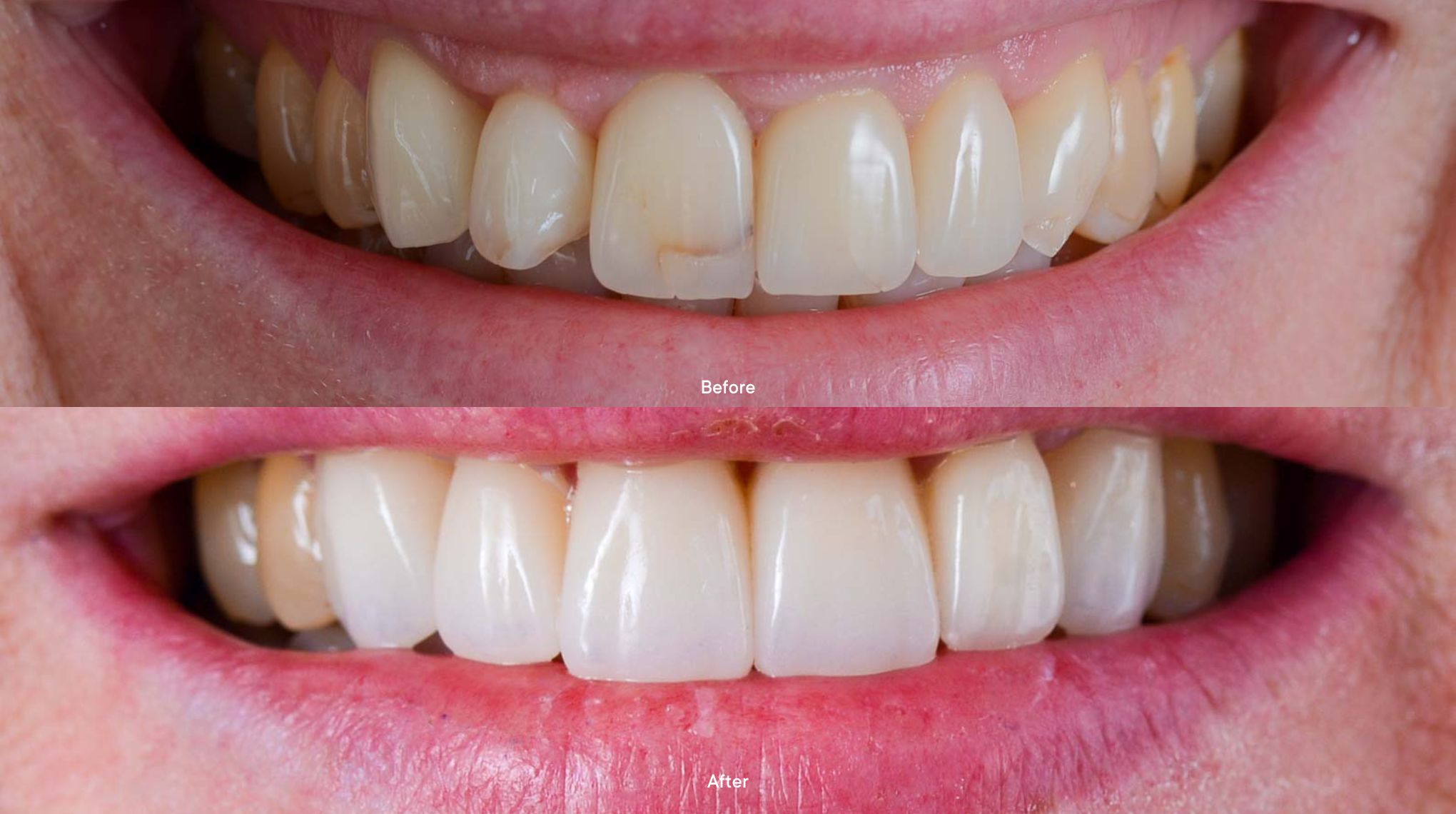 Dental Veneers Melbourne Porcelain Veneers Mulgrave Dental
